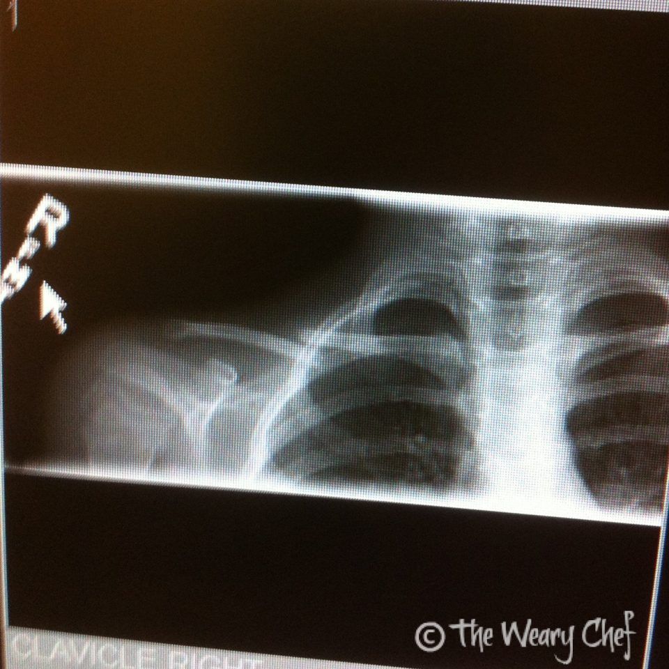 Mega Clavicle Fracture